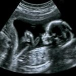 20 savaitės echoskopas